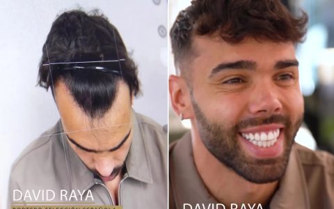 Arsenal Goalkeeper David Raya Undergoes Hair Transplant Surgery: Fans Comment on a Transformed Defense Line