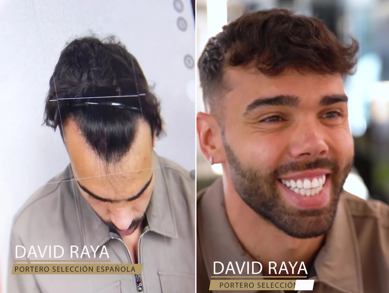 Arsenal Goalkeeper David Raya Undergoes Hair Transplant Surgery: Fans Comment on a Transformed Defense Line