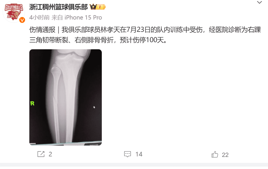 Official Statement from Zhejiang Men's Basketball Team: Lin Xiaotian Sustains Right Ankle Triangular Ligament Tear and Right Fibular Fracture; Expected to be Out for 100 Days